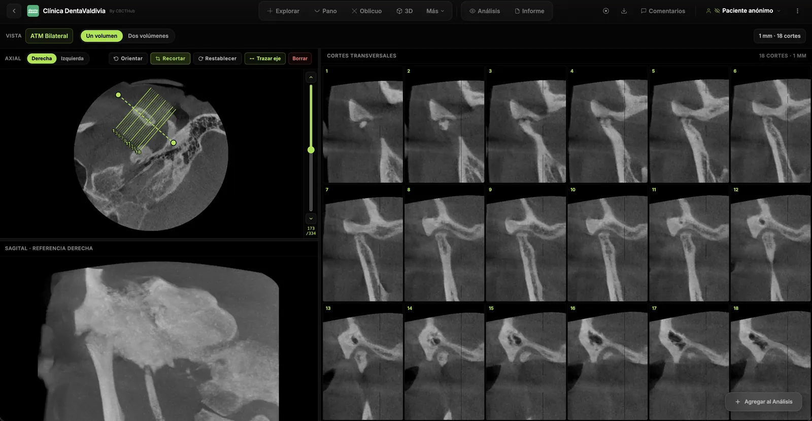 Articulación temporomandibular
