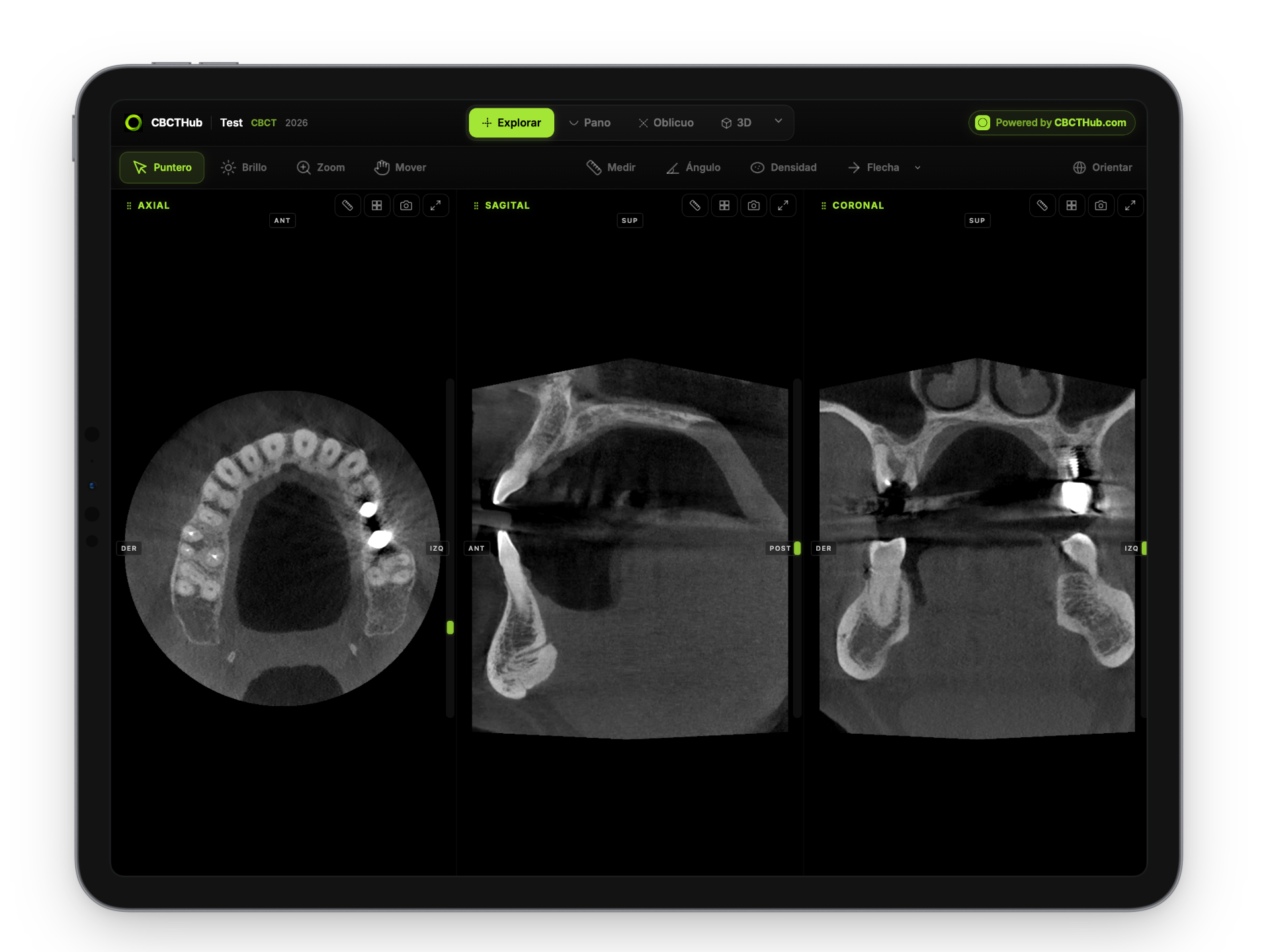 CBCTHub viewer showing the axial, sagittal and coronal slices of a dental scan