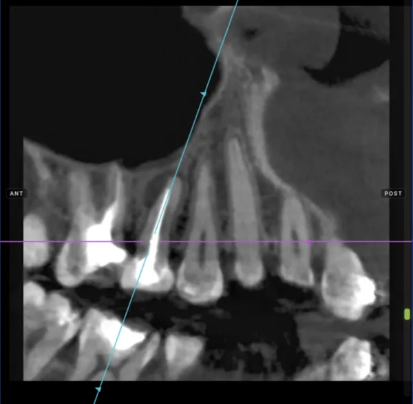 Oblique slices