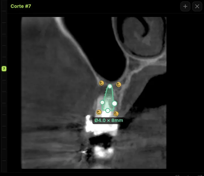 Implant planning